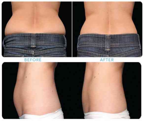 coolsculpting-before-and-after