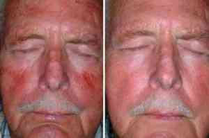 pdt_rosacea_sandiego_before_after-300x199