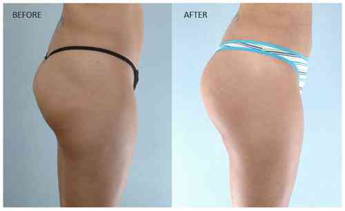 Butt-Lift-Buttock-Enhancement-Before-and-After-Photo