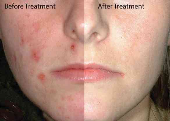 foto-de-acne-antes-e-depois-do-tratamento